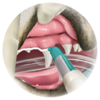 Applying Barrier Sealant with a gun to the gum line