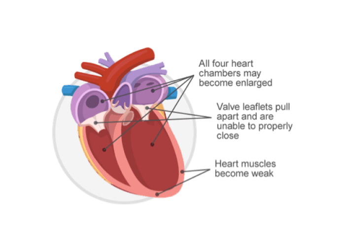 An image of a heart with DCM