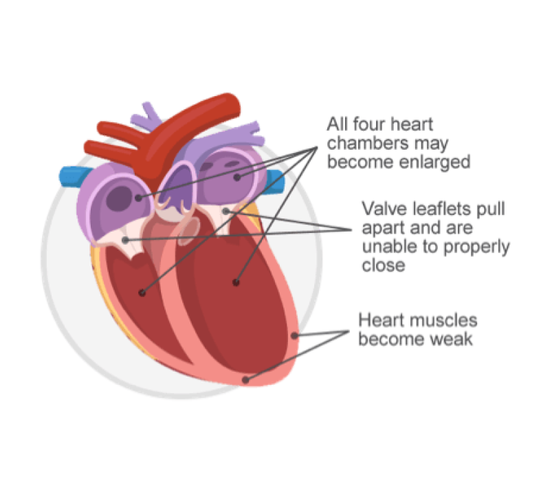 An image of a heart with DCM