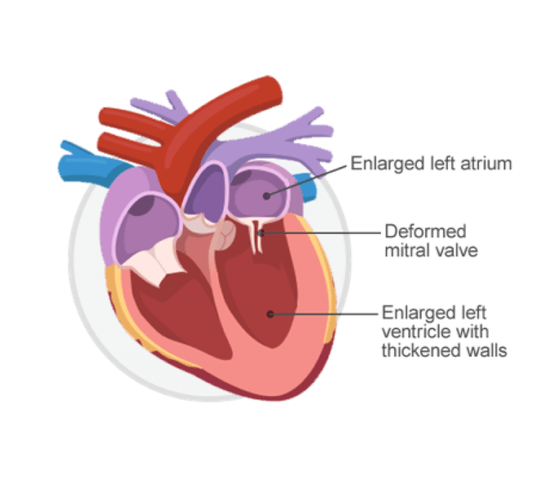Image of a heart with MMVD. 